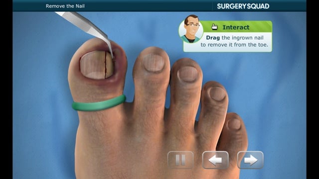 Ingrown Toenail Diagram | 2017 - 2018 Best Cars Reviews