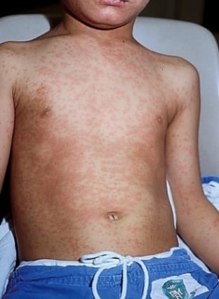 worried about measles