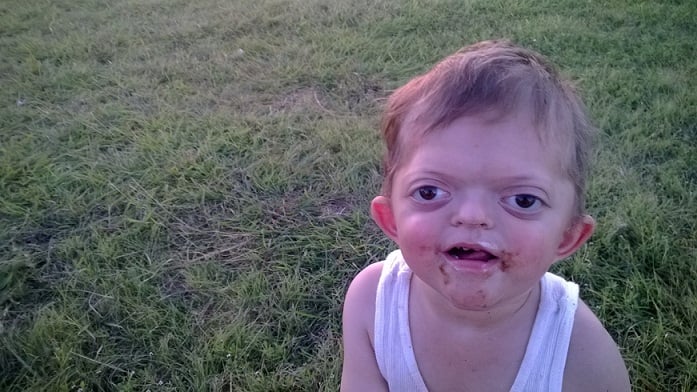 What it's like having a son with Pfeiffer syndrome