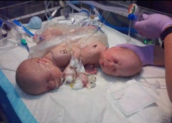 Conner and Carter conjoined twins