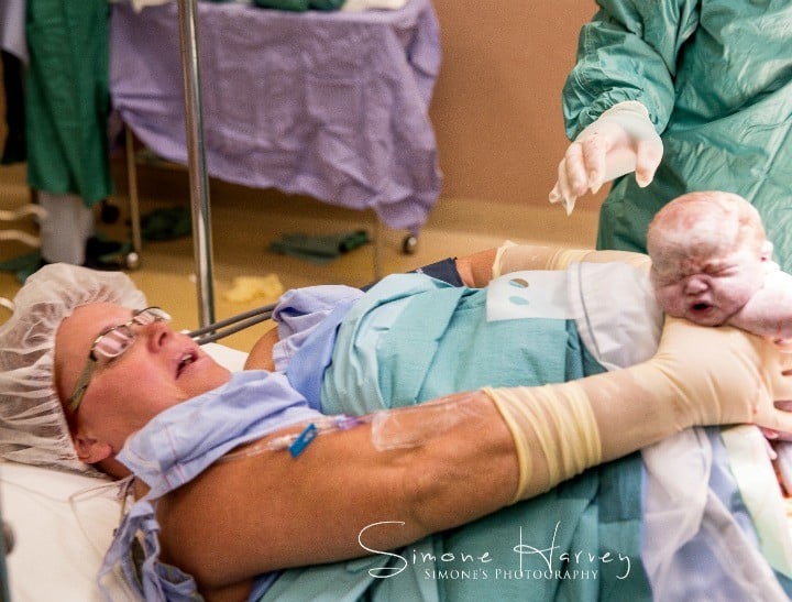 maternal assisted caesarean