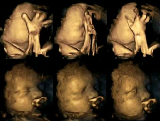 Ultrasound smoking effect on babies