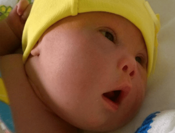 down syndrome baby abandoned