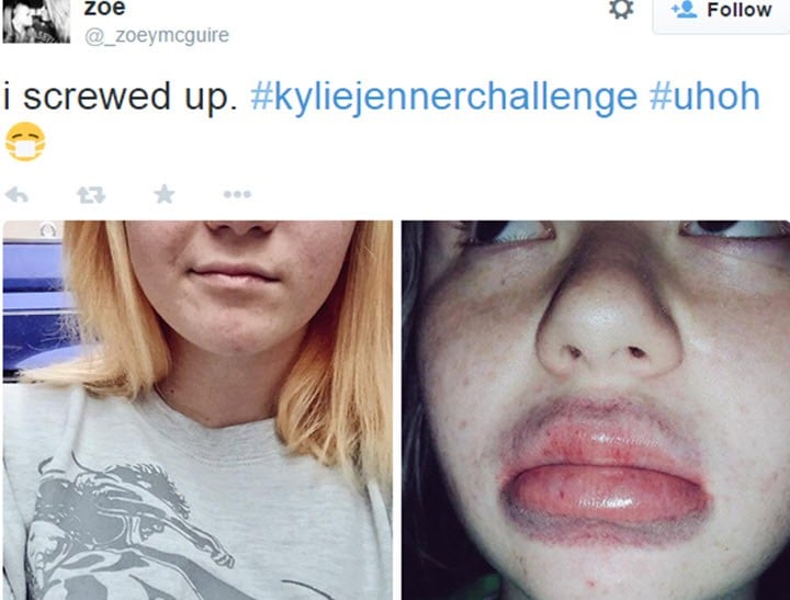 Teens Do Kylie Jenner Lip Challlenge