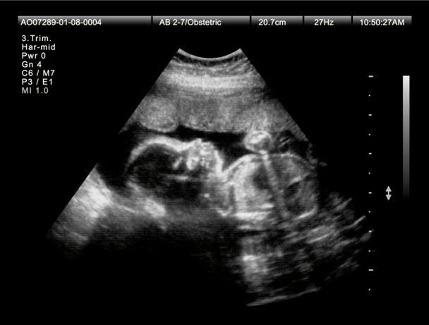 embryo donation