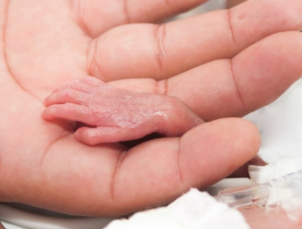 babies survive at 22 weeks