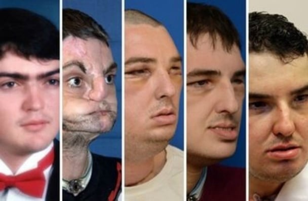 face transplant