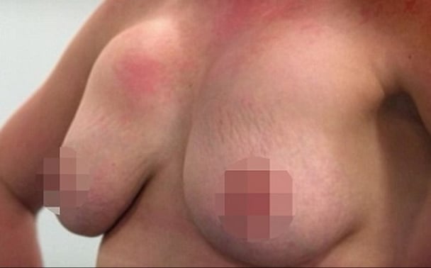 botched breast implants