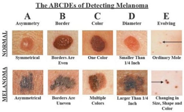 Georgie Gardner skin cancer