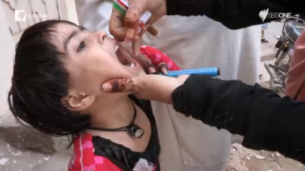 polio 423