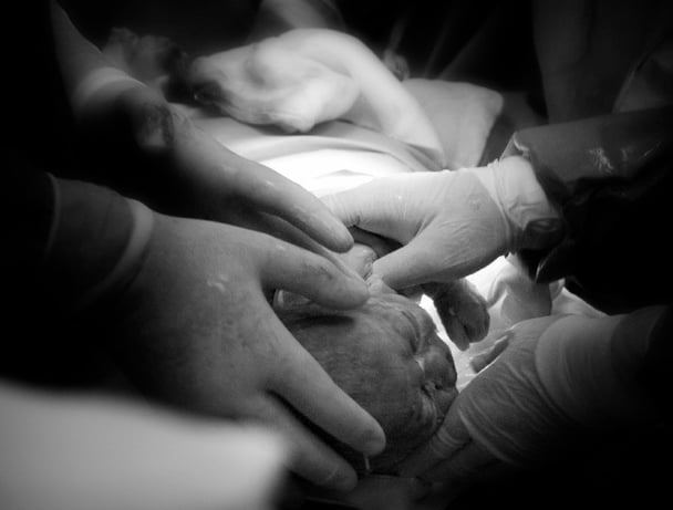 cesarean babies chronic illness