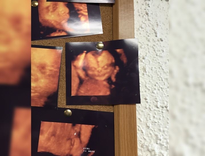 Creepy baby ultrasound