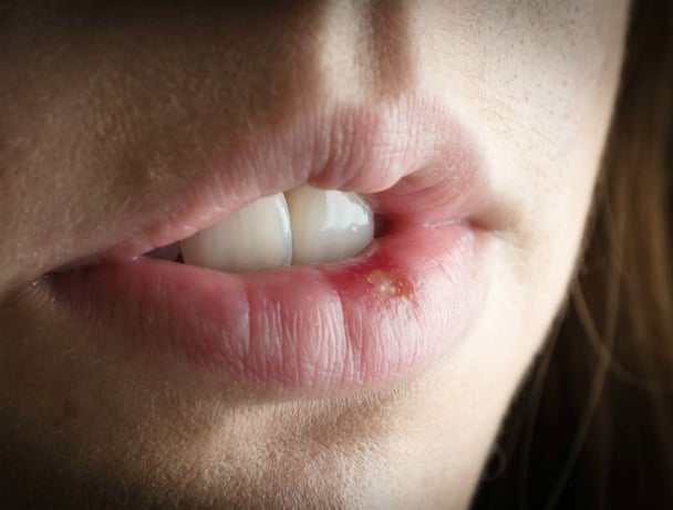 cold sore remedies