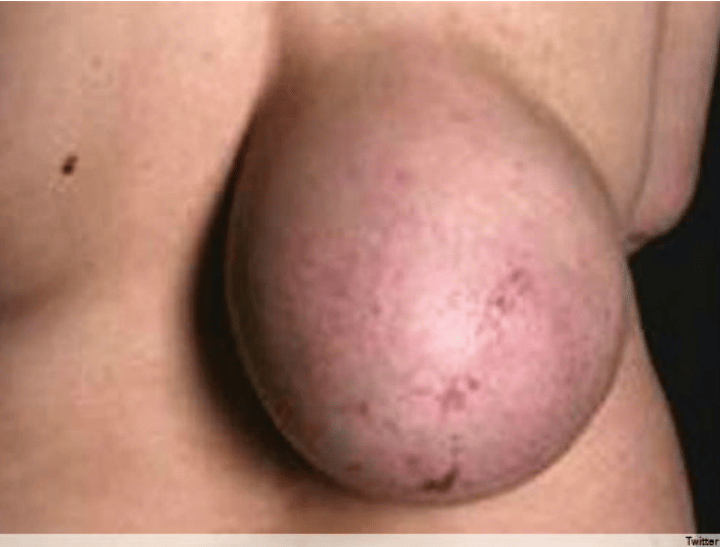 breast tumour back1feature