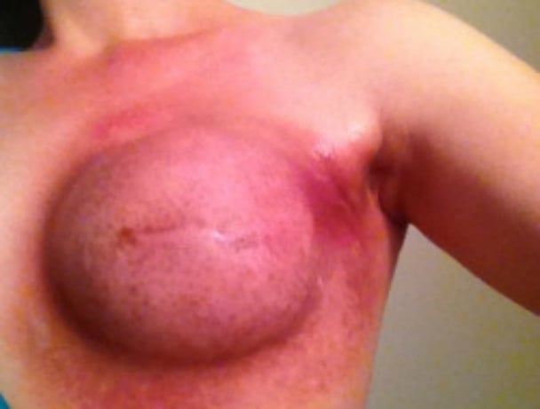 breast cancer photos