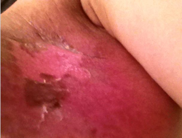 breast cancer photos