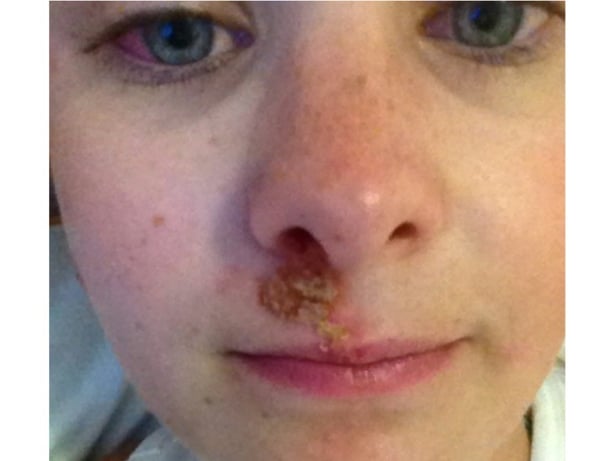 Amy pimple part 1