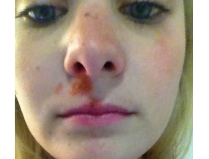 Amy pimple part 2