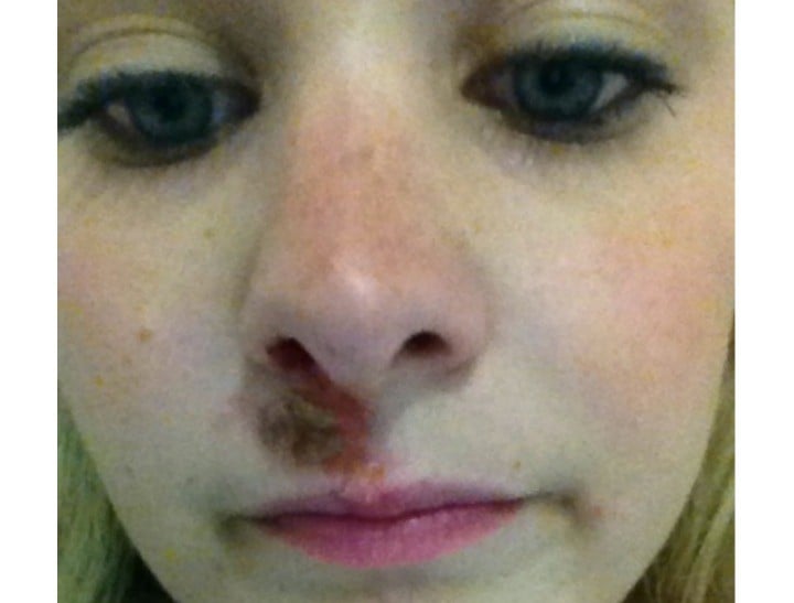 Amy pimple part 3