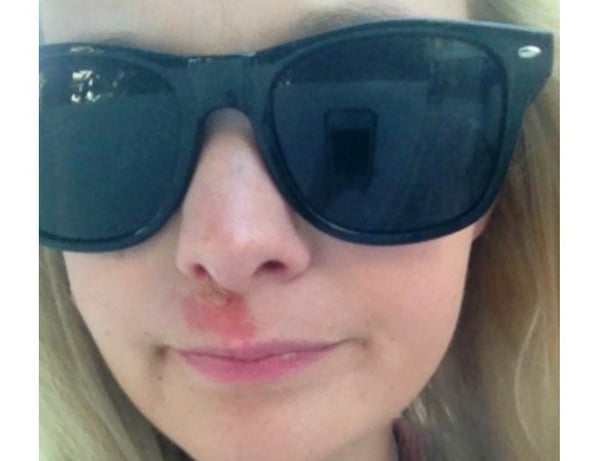 Amy pimple part 4