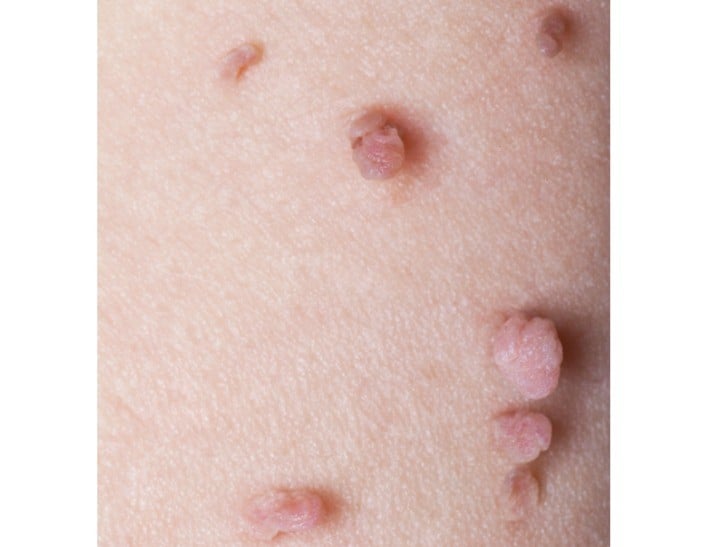 pictures of skin tags on anus or rectum