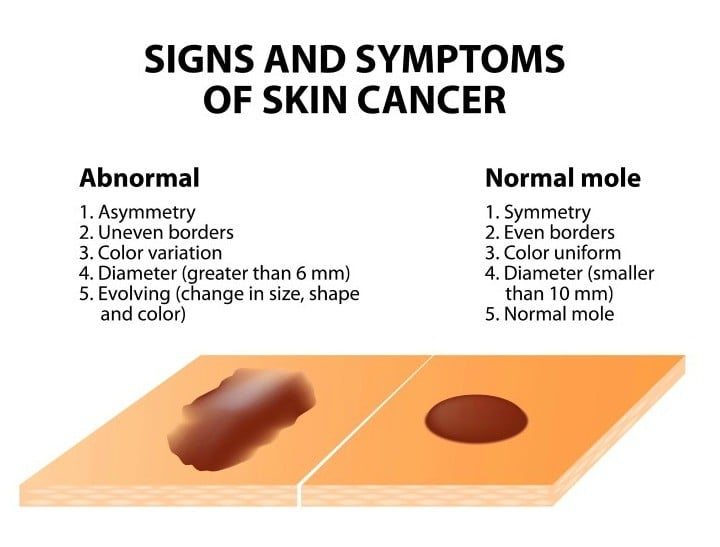 Skin cancer symptoms - what to look out for | SkinVision