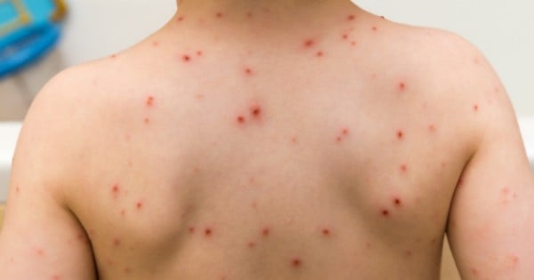 sunrise chicken pox