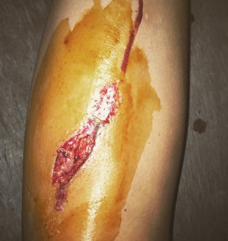accident changed the way I thought about my body