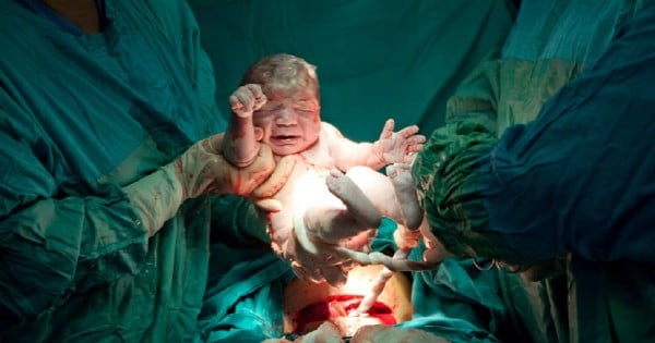 caesarean in progress