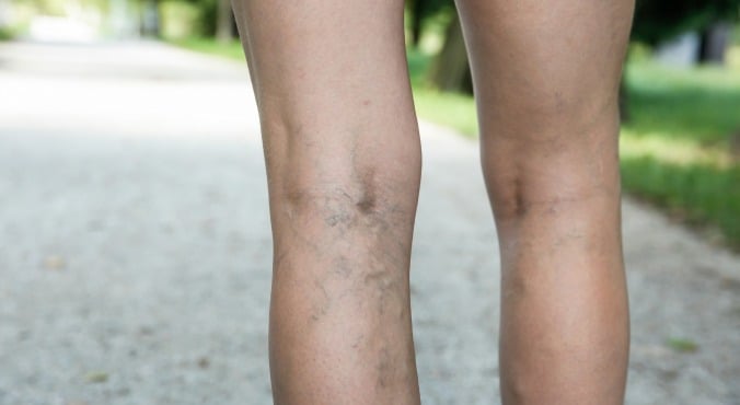 Varicose Vein Treatment Melbourne