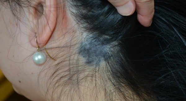 What Causes Birthmarks And Can They Be Treated