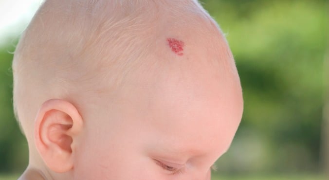 birthmark-stock-image-m120-0202-science-photo-library