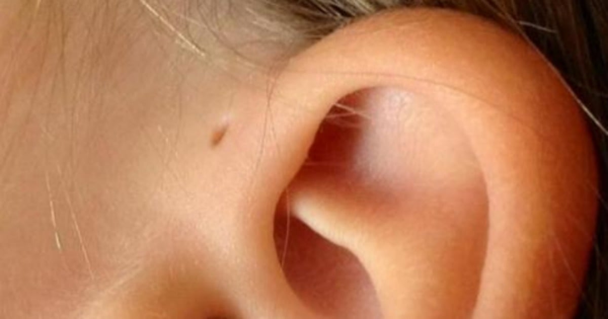 one-in-100-people-have-this-hole-above-ear-this-is-why