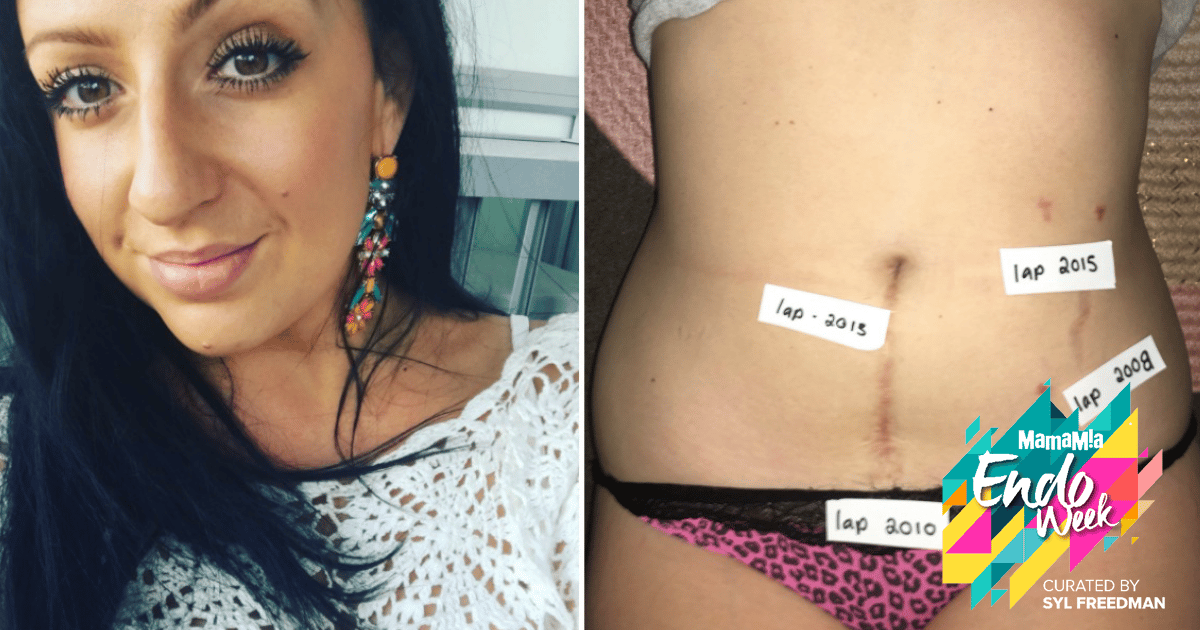 pregnancy with endometriosis