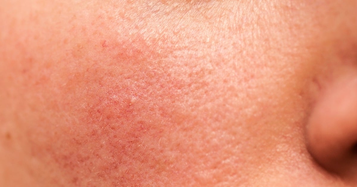 vitamin a deficiency skin bumps