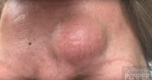 Dr pimple popper egg yolk