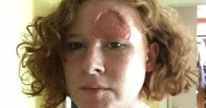 pregnancy side-effect skin cancer