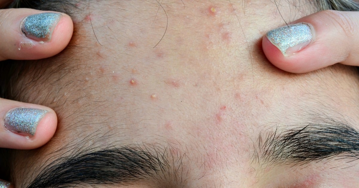 small-bumps-that-aren-t-pimples-on-face-general-acne-discussion