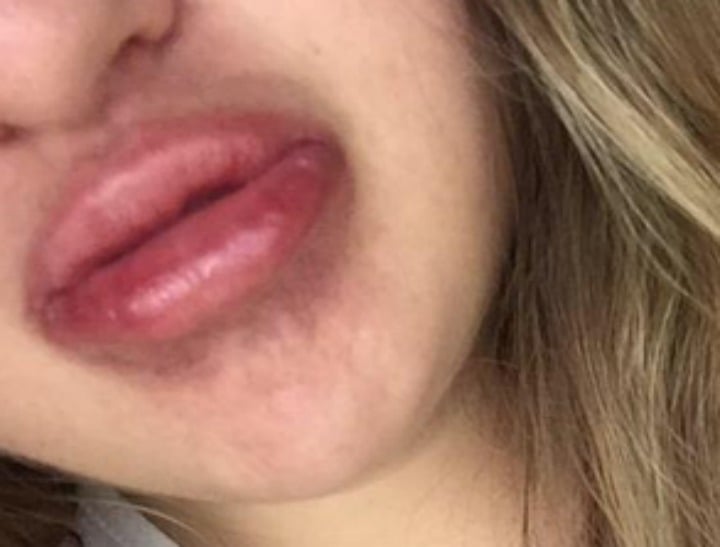 Kylie Jenner Lip Challenge Aftermath