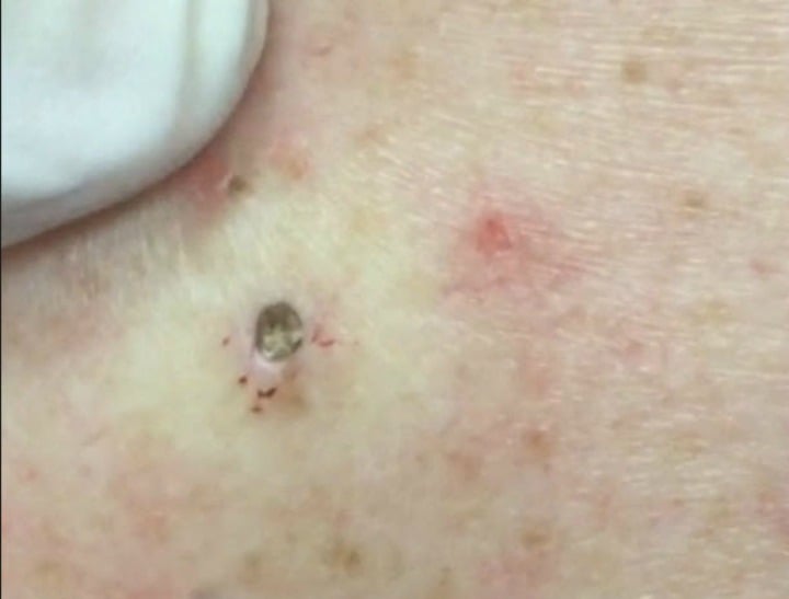 This Dr Pimple Popper blackhead removal left us gagging.