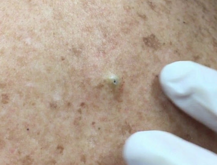 Dr Pimple Popper Has Become An Online Sensation