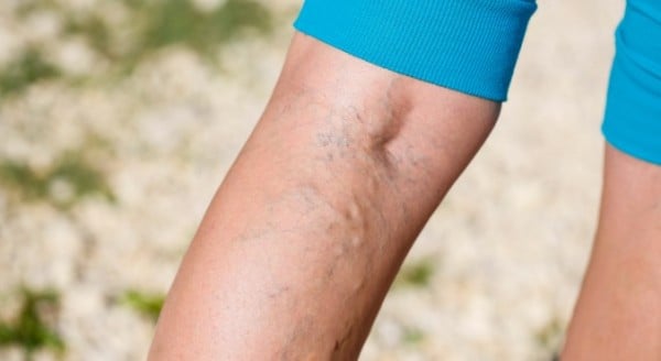 Varicose Vein Treatment Melbourne