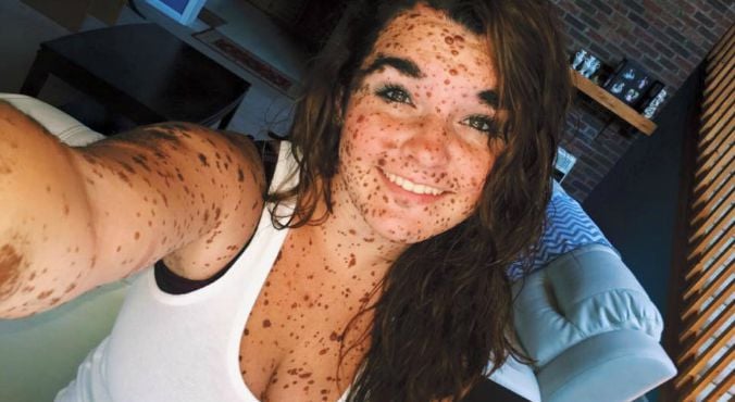 US teen on living with Giant Congenital Melanocytic Nevus.