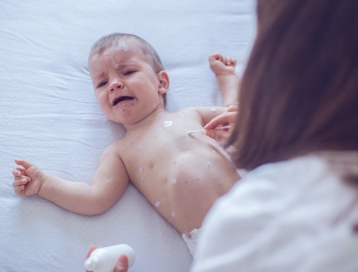 brunswick measles outbreak