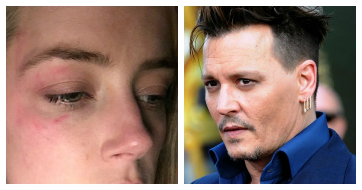 photos of amber heard injuries