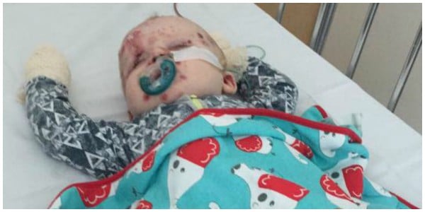 babies with chickenpox