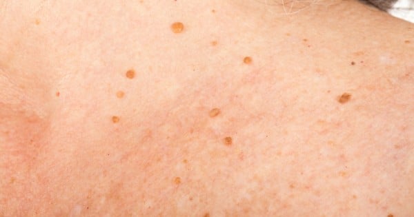 genital skin tags pregnancy