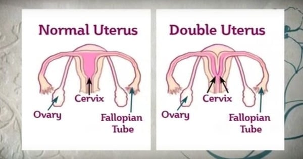 Pictures of women with 2 vaginas