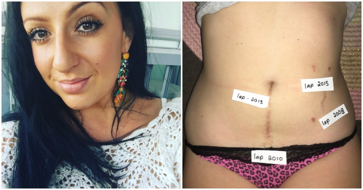 pregnancy with endometriosis