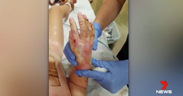 Child trapped under treadmill suffers horrific burns and injuries.